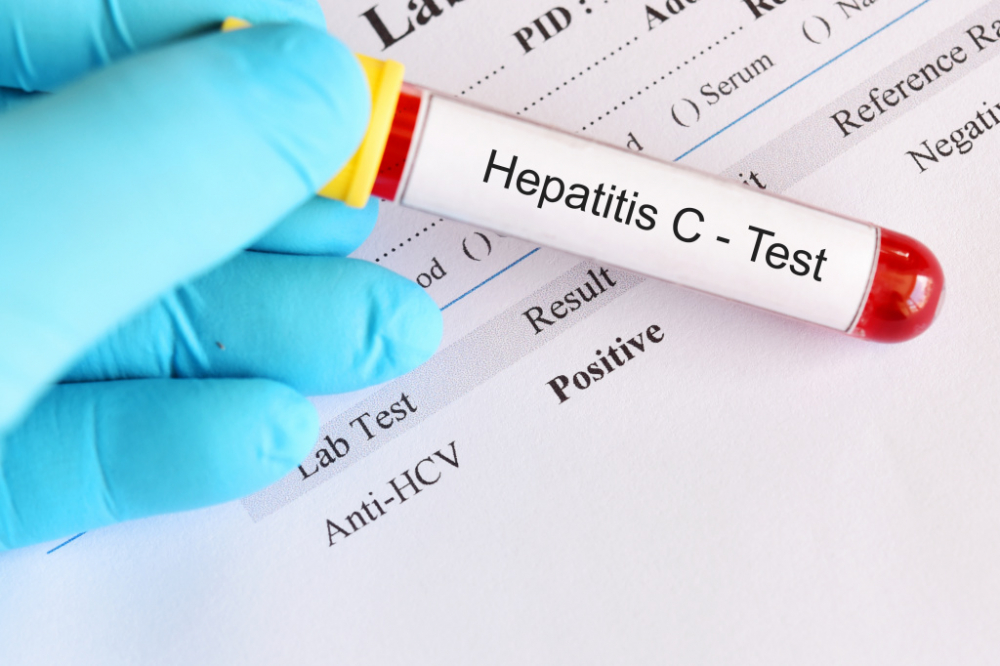 What is HCV blood test and transcript - MHP